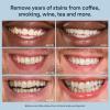 imageAuraglow 35 Teeth Whitening Gel Syringe Refill Pack 35 Carbamide Peroxide 30 Whitening Treatments 3 5mL Whitening Gel Syringes Sensitive Teeth Whitening22 Teeth Whitening Gel