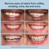 imageAuraglow 35 Teeth Whitening Gel Syringe Refill Pack 35 Carbamide Peroxide 30 Whitening Treatments 3 5mL Whitening Gel Syringes Sensitive Teeth Whitening35 Teeth Whitening Gel