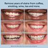 imageAuraglow 44 Teeth Whitening Gel Syringe Refill Pack 44 Carbamide Peroxide 3X 5ml Syringes 30 Whitening Treatments44 Teeth Whitening Gel