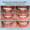 imageAuraglow Teeth Whitening Strips Sensitive Whitening Strips 14 Whitening Treatments 8 Hydrogen Peroxide with Nano Hydroxyapatite nHAp to Reduce Sensitivity and Protect Enamel 28 Strips Mint2 Fl Oz Pack of 1